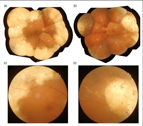 Figure 1 From Bilateral Intraocular And Lung Involvements Associated With Nasal Nkt Cell