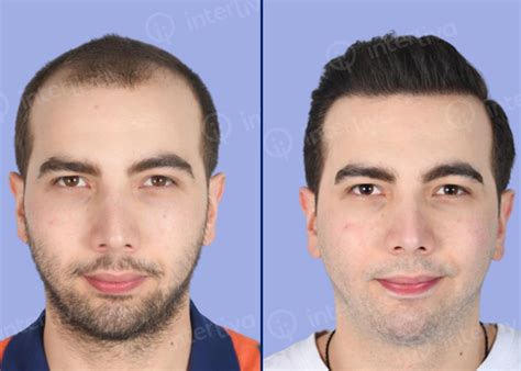 Hair Transplant Before And After Photos Interliva Hair