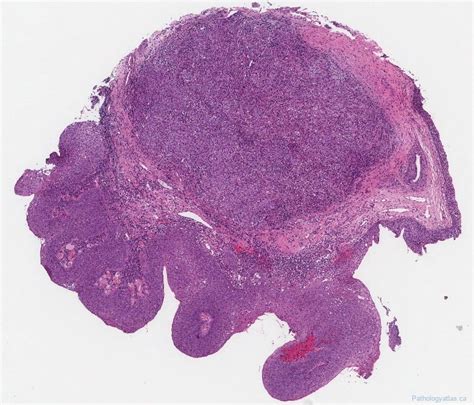 Papillary Squamous Cell Carcinoma Of The Larynx Ottawa Atlas Of Pathology