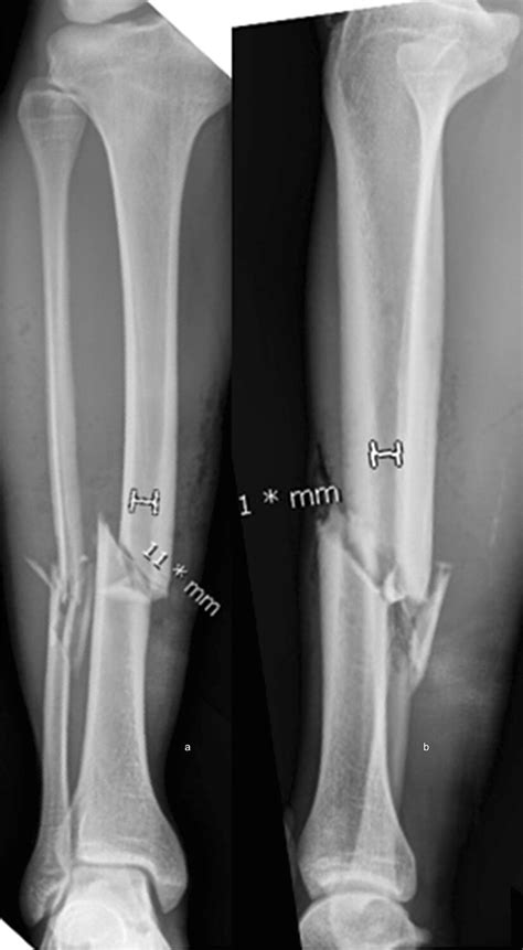 Measurement of the diameter of the medullary canal on AP and lateral ...