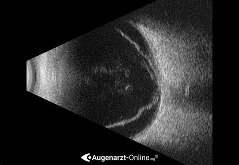 Ablatio Retinae Atlas Der Augenheilkunde