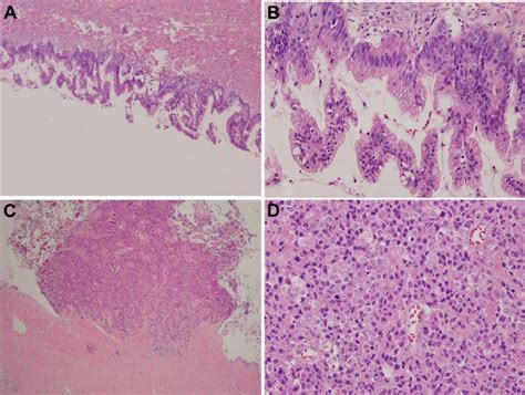 Mucinous Borderline Tumor And Large Cell Neuroendocrine Carcinoma The