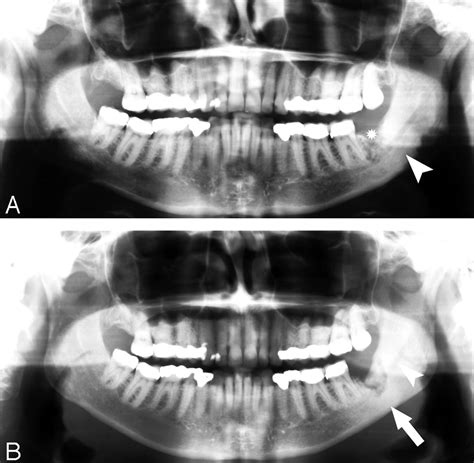 Osteonecrosis Of The Jaw Radiograph