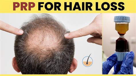 Prp Hair Treatment In Chennai Platelet Rich Plasma For Hair Loss Tamiralife Chennai Youtube