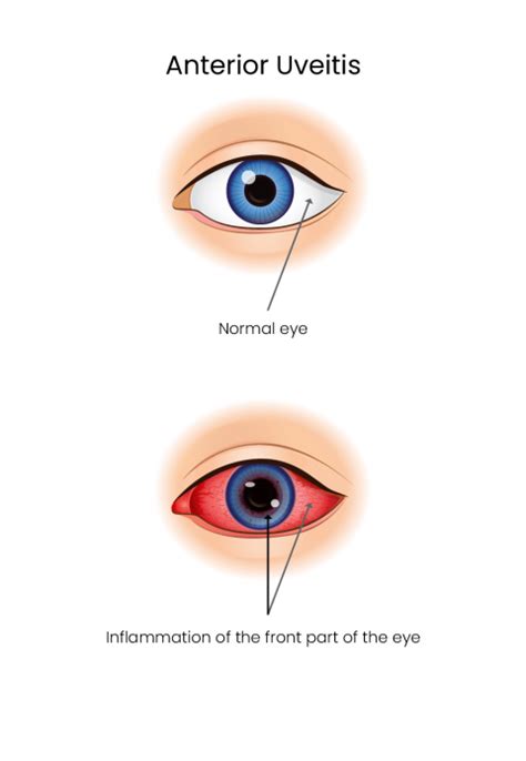 Uveitis Ophthalmologist Brisbane Eye Doctor Brisbane The Eye