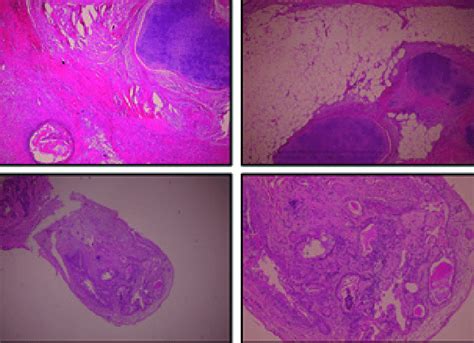 Mature Teratoma Presence OF Well DiFFerentiated Structures OF