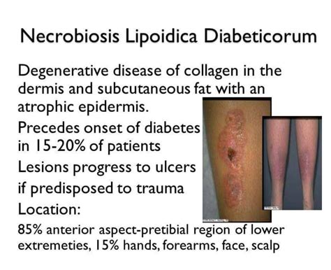 Necrobiosis Lipoidica Diabeticorum