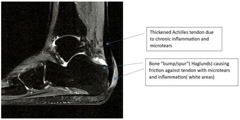 Achilles Tendinitis Treatment In Singapore Orthocare Sg