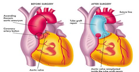 Aortic Aneurysm Surgery And Repair How Its Done Risks What To Expect