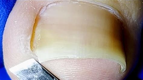 Inflamed Ingrown Toenail On One Side Remove ImpuritiesXue Yidao