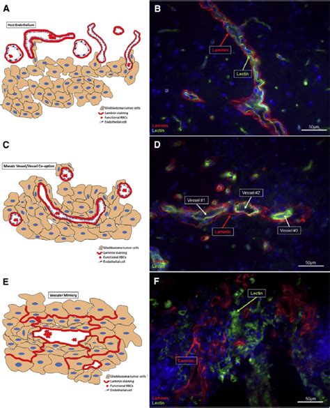 Schematic Of Vascular Mimicry Development Driving Anti Angiogenic