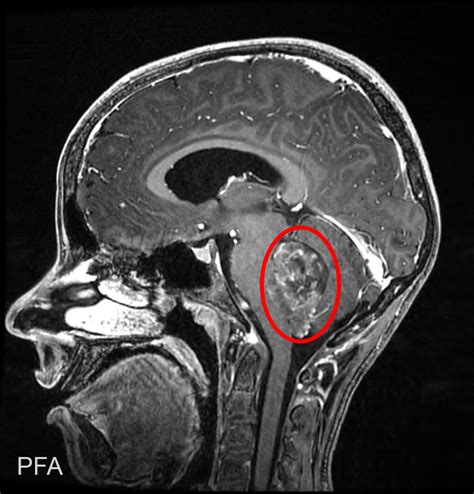 Ependymoma Brain Tumor