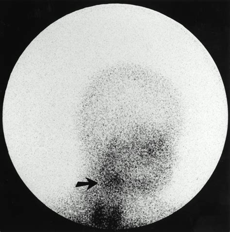 Somatostatin Receptor Scintigraphy In The Initial Staging Of Low Grade