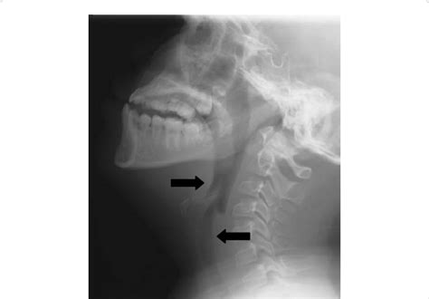 Lateral Soft Tissue Neck X Ray Anatomy