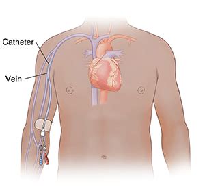 Understanding a Midline Catheter | Saint Luke's Health System