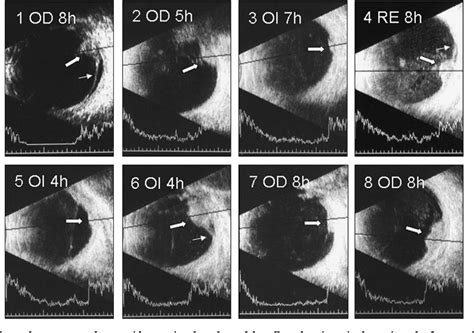 Figure 2 From Ultrasound Diagnosis In Vasoproliferative Tumours Of The