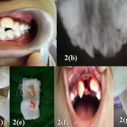 A Preoperative View 1B Occlusal 1C Periapical View Showing Impacted