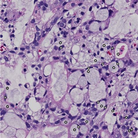 Signet Ring Cell Classification Download Scientific Diagram