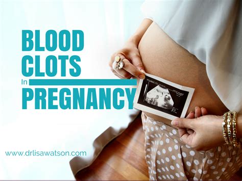 Blood Clots in Pregnancy | Dr. Lisa Watson