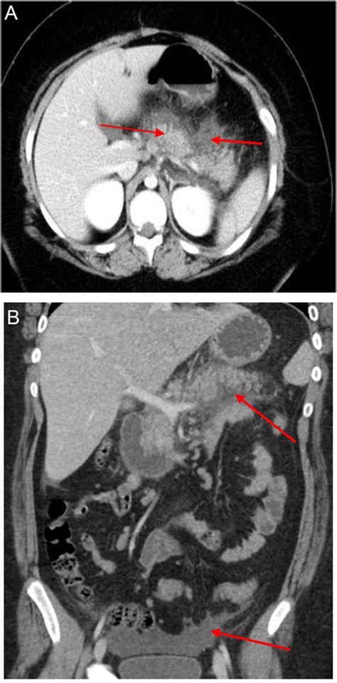 Ct Scan Abdomen Showing A Oedematous Pancreas With Peripancreatic