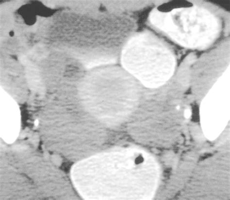 Imaging Of Ovarian Fibromatosis Ajr