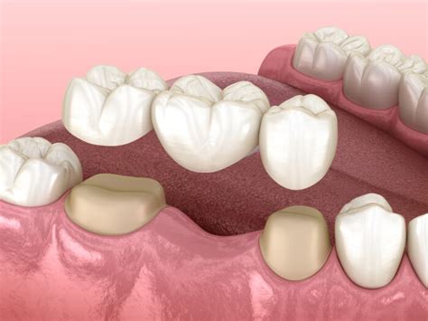 How Do Dental Bridges Work Windmill Dental Amarillo Tx