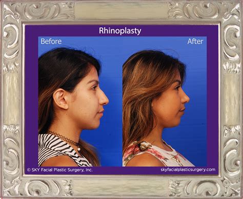 Rhinoplasty Nose Job San Diegos Best Rhinoplasty Surgeon — Sky