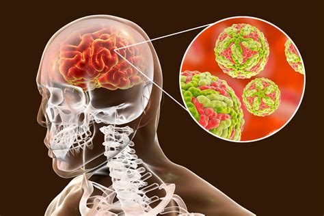 Manifestações neurológicas na emergência quando suspeitar de meningite