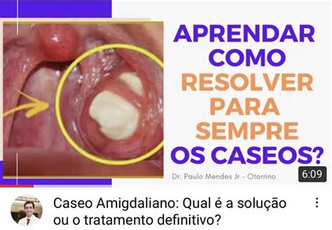 Caseo Amigdaliano