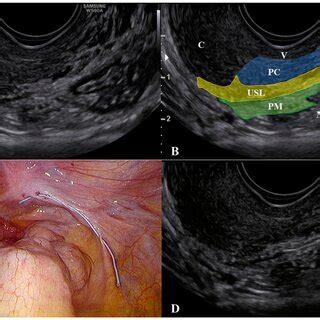 An isolated lesion of endometriosis of the left uterosacral ligament ...