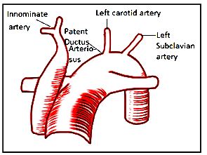 Type-B interrupted aortic arch. The interruption occurs between the... | Download Scientific Diagram