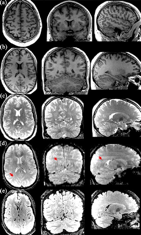 Brain MRI images of a TBI victim who fell from a helicopter during a... | Download Scientific ...