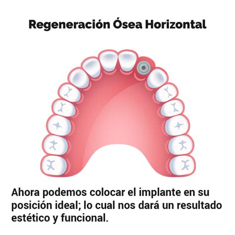 Regeneración Ósea Guiada Dental Life Especialistas en Servicios