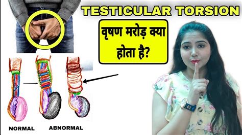 Testicular Torsion Symptoms Diagnosis Treatment In Hindi वृषण मरोड़ क्या क्योंकब होता है