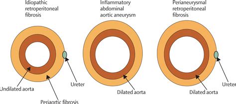 Retroperitoneal Fibrosis Ultrasound