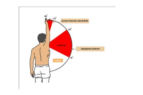 Subacromial Shoulder Impingement Syndrome 43 Off