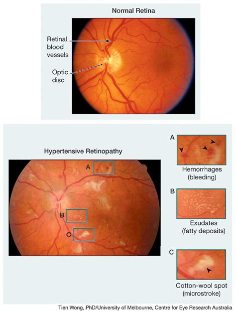 Retinopathy Ophthalmology Jama Jama Network