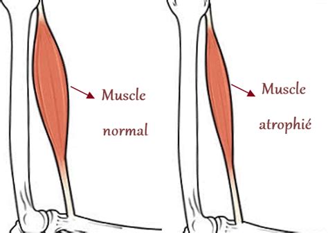 Atrophie Musculaire De Quoi Sagit Il