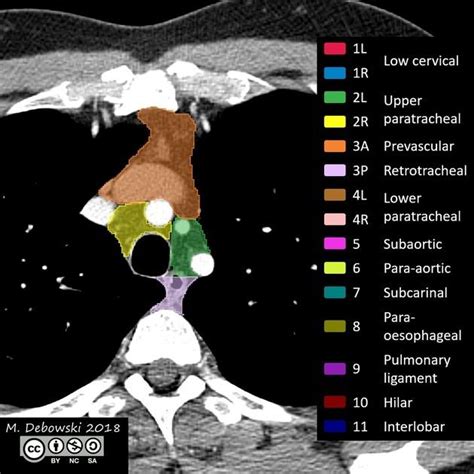 Understanding Thoracic Lymph Node Stations Radiopaedia - Kadinsalyasam.com