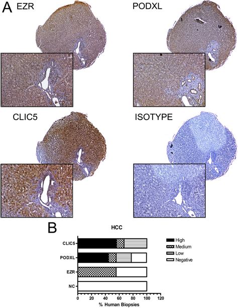 Differential Expression Of EZR CLIC5 And PODXL In Human Biopsies A