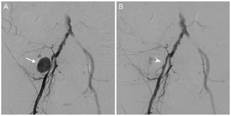 Angiography Showing A A Pseudoaneurysm Of The Right External Iliac Download Scientific