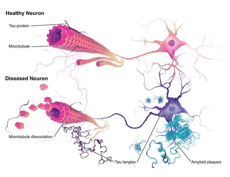 The Biology of Health: Removing Tau Protein in Alzheimer's Disease: A ...