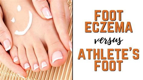 Types Of Foot Eczema Vs Athlete S Feet Symptoms Causes Natural