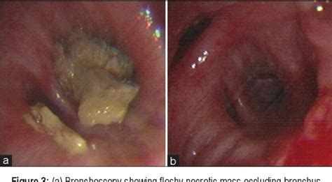 Figure 3 From Endobronchial Aspergilloma Mimicking Bronchogenic