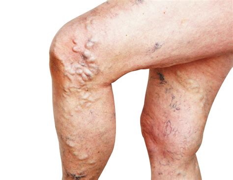 What Are Bulging Veins Causes Treatments The Vein Institute