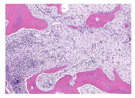 Chronic Nonbacterial Osteomyelitis Hss Case