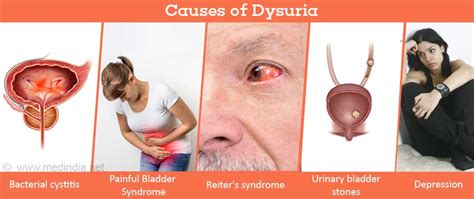 Dysuria Painful Micturition Painful Urination Symptom Evaluation