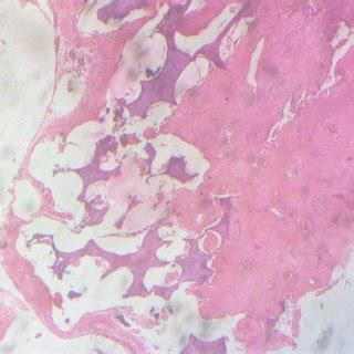 Photomicrograph Showing Follicle Of Odontogenic Epithelium Resembling