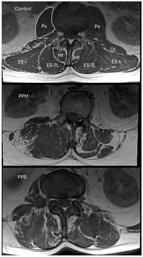 Jcm Free Full Text Differentiation Of Post Polio Syndrome From