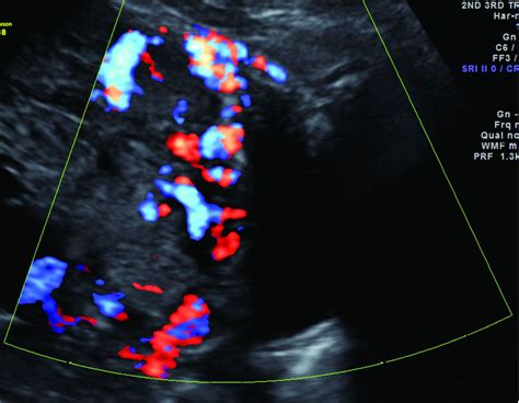 Placenta Positions On Ultrasound